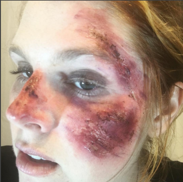 road rash on face